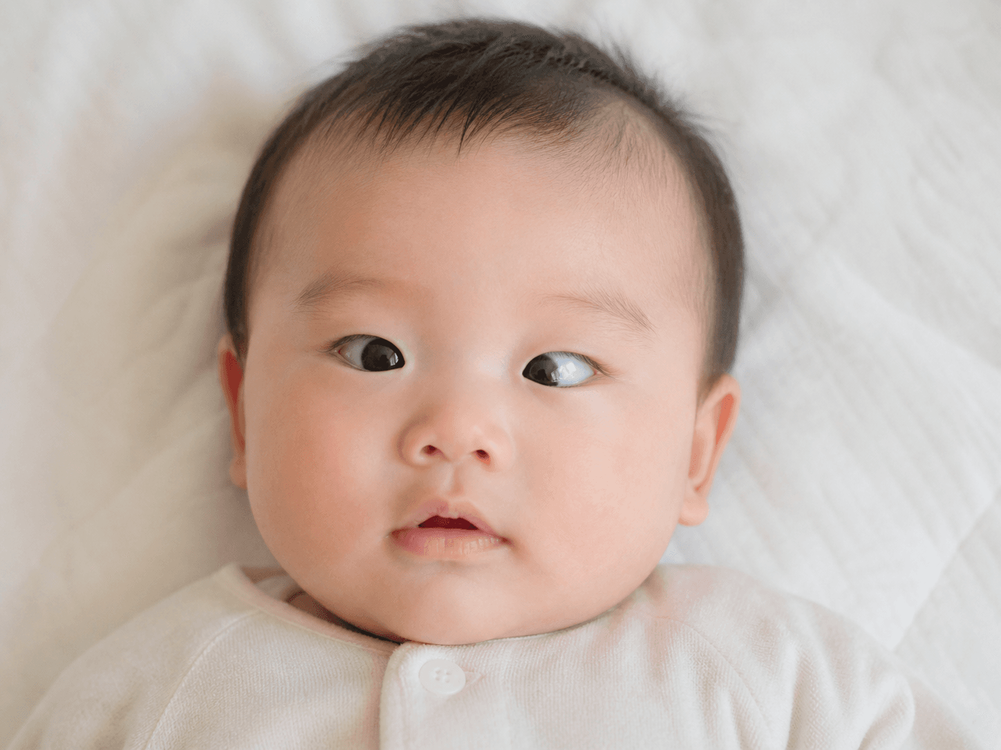 선천성 사시