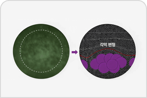 기존 스마일 레이저 조사
